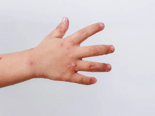 red rash on baby hands Hand-foot-and-mouth disease HFMD enterovirus Coxsackie virus infection Isolated virus disease on white background