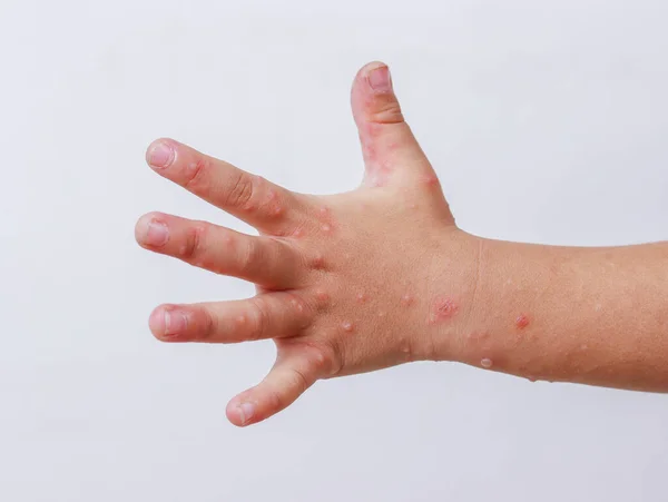 Choroba Rąk Nóg Hfmd Ludzka Ręka Szkarlatyny Enterowirusie Palmowym Wirus — Zdjęcie stockowe