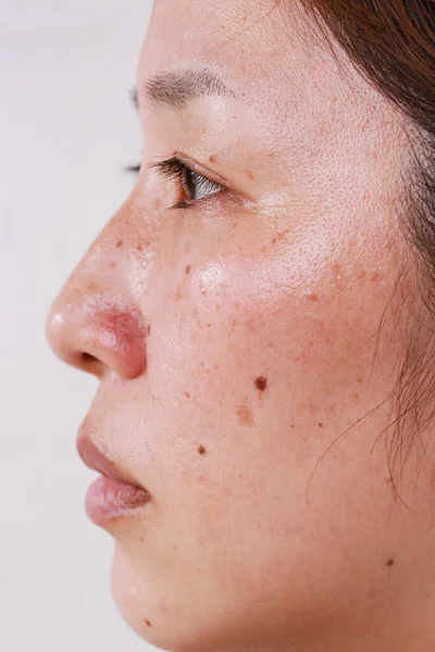 Close-up of a woman\'s face, half face, portrait with large pores black dots care for problem skin and white background