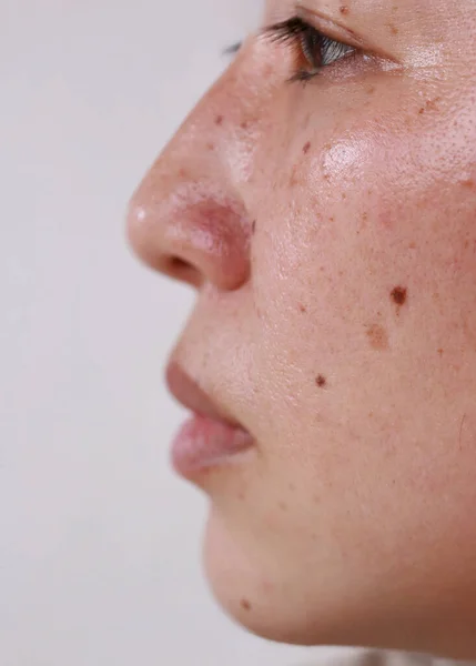 Half face of a woman\'s face with black dots oily face skin health problems to treat a dermatologist and copy space