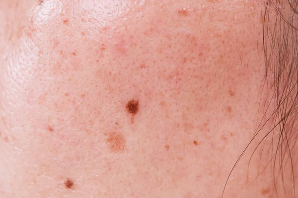 Problems with oily skin with freckles and dark spots Macro close-up of facial woman