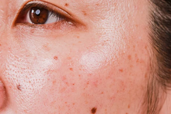 Problemas Cuidado Piel Conceptos Salud Arrugas Poros Pecas Manchas Oscuras — Foto de Stock