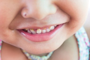 Dişleri kırılmış ve çürümüş küçük bir çocuk..