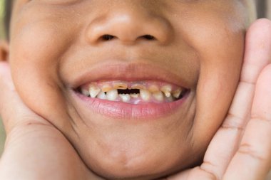 Dişleri kırılmış ve çürümüş küçük bir çocuk..