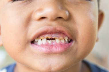 Dişleri kırılmış ve çürümüş küçük bir çocuk..