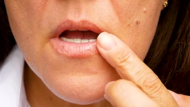 Dziewczyna Smarowała Usta Maścią Opryszczkę Zbliżenie Leczenie Opryszczki Ustach Maści — Wideo stockowe