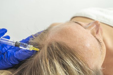 Mezoterapi prosedürü. Bir kozmetik uzmanı bir kadının kafasında mezoterapi prosedürü uygular. Saçları güçlendiriyor ve uzuyor..