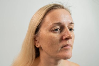 Beyaz arka planda derinin gerçek biyo-evrimleşmesi. Bir kadının yüzünde biyo-evrim enjeksiyonu izleri var. Biorevyalizasyon iğnesi izleri