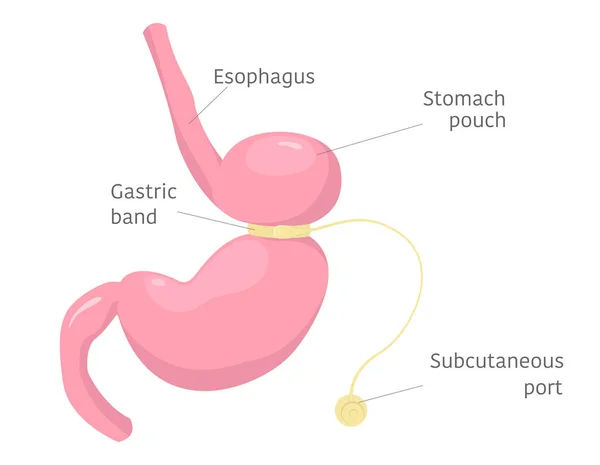 胃の調節可能な胃バンド インフォグラフィック アトラス 教科書や教材のための人間の解剖図 ベクターイラスト — ストックベクタ