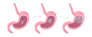 Mideye bir mide balonu yerleştirmek. Kilo verme yöntemleri. Bariatri. Infographics, atlas, ders kitabı veya çalışma materyalleri için insan anatomisi çizimi. Vektör illüstrasyonu