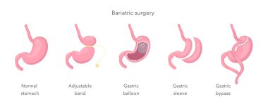 Mide baypası, kol, balon, bant. Kilo verme yöntemleri. Bariatri. Infographics, atlas, ders kitabı veya çalışma materyalleri için insan anatomisi çizimi. Vektör illüstrasyonu