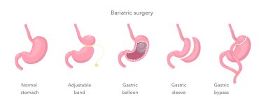 Gastric bypass of stomach, sleeve, balloon, band. Methods of weight loss surgery. Bariatry. Human anatomy illustration for infographics, atlas, textbook or study material. Vector illustration clipart