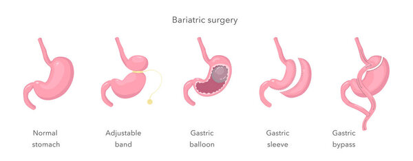 Gastric bypass of stomach, sleeve, balloon, band. Methods of weight loss surgery. Bariatry. Human anatomy illustration for infographics, atlas, textbook or study material. Vector illustration