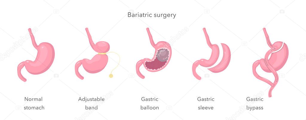 Gastric bypass of stomach, sleeve, balloon, band. Methods of weight loss surgery. Bariatry. Human anatomy illustration for infographics, atlas, textbook or study material. Vector illustration