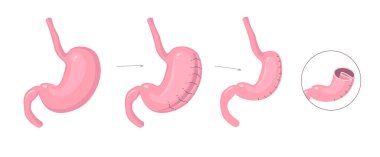 Gastrik plikasyon bilgisi. Mide resminin açıklaması laparoskopik ameliyat yoluyla metodu azaltır. Vektör illüstrasyonu