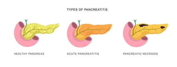 Infographics Demonstrating Difference Pancreatitis Pancreatic Necrosis Disease Diagnostic Procedure Illustration — Stock Vector