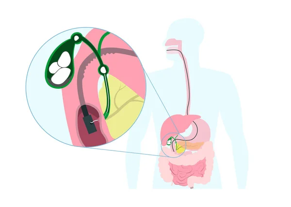 Endoscopic Removal Gallbladder Stone Mouth Stomach Bile Duct Medical Operation — Διανυσματικό Αρχείο