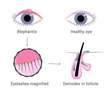Demodex enfeksiyonu kanamaya neden oluyor. Kirpik akarları mikroskop görüntüsü. Kirpik saç kökleri içinde demodeks maytı. Göz kapağı şişmiş. - Evet. Vektör illüstrasyonu