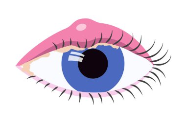 Human eye with swelled eyelid. Blepharitis. Eyeball inflammation medical llustration. Vector illustration clipart