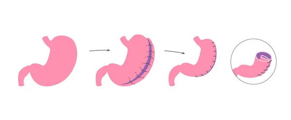 Gastric Plication Flat Infographics Explanation Picture Stomach Reduce Method Laparoscopic — ストックベクタ