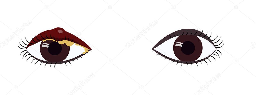 Dark brown eyes comparison of healthy state and blepharitis symptoms, swelling, mucus. Eye disease medical illustration. Vector illustration