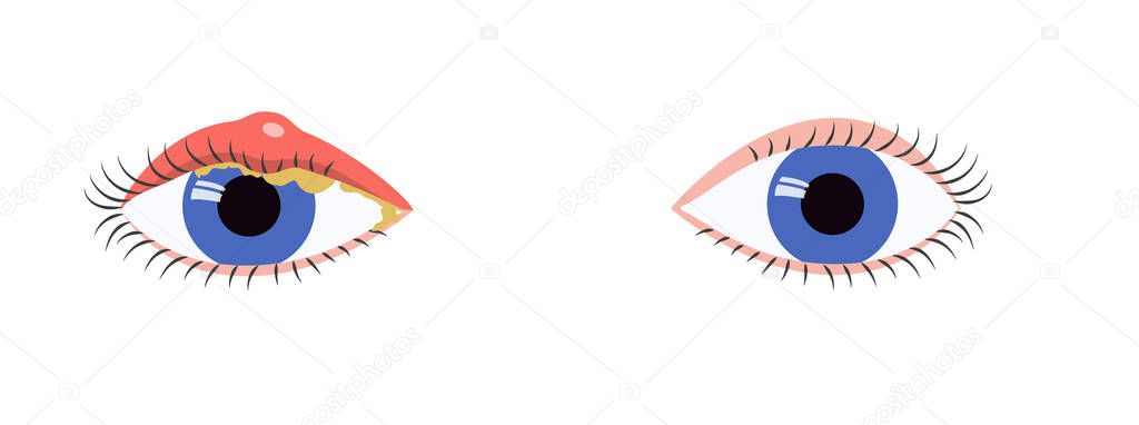 Blue eyes comparison of healthy state and blepharitis symptoms, swelling, mucus. Eye disease medical illustration. Vector illustration