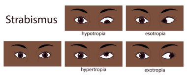 Strabismus flat style infographic set of stages: normal and disorders. Vector illustration