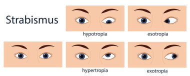 Strabismus flat style infographic set of stages: normal and disorders. Vector illustration clipart