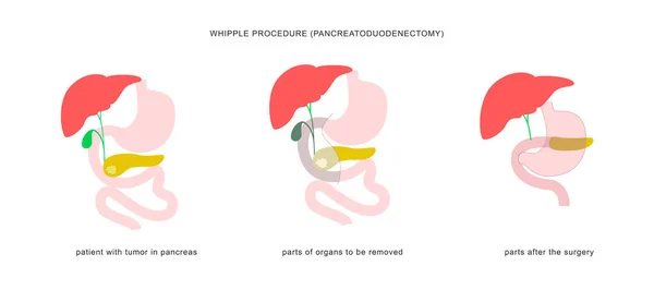 Medical Infographic Whipple Procedure Pancreaticoduodenectomy Surgery Operation Treatment Pancreatic Cancer — Stock Vector