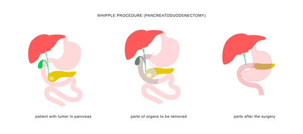 Медична Інфографіка Процедури Шипування Підшлункової Ендодектомії Операція Хірургії Лікуванні Раку — стоковий вектор