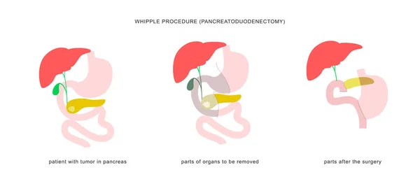 Medical Infographic Whipple Procedure Pancreaticoduodenectomy Gastrojejunostomy Surgery Operation Treatment Pancreatic — Stock Vector