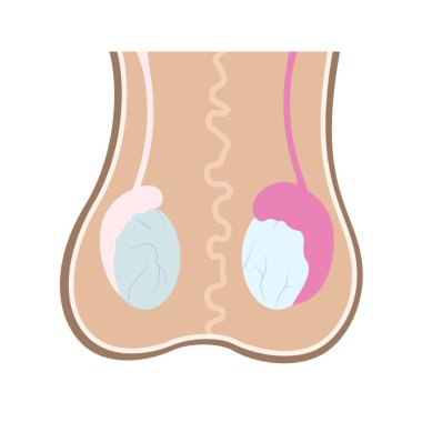 Illustration of epididimis inflamation on one of testicles compared to healthy one. Infographics in human anatomy for educational and marketing materials. Vector illustration