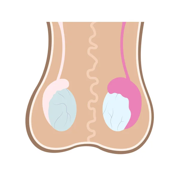 Illustration Epididimis Inflamation One Testicles Compared Healthy One Infographics Human — Vetor de Stock