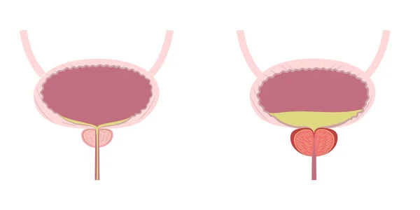 Descriptive Illustration Enlarged Inflamed Swelled Prostate Healthy Prostate Vector Illustration — Image vectorielle