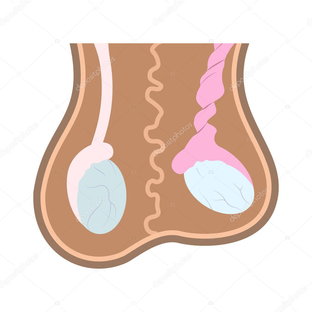Illustration Of Normal Testicle And Testicle Torsion In Scrotum Medical Chart Of Reproductive