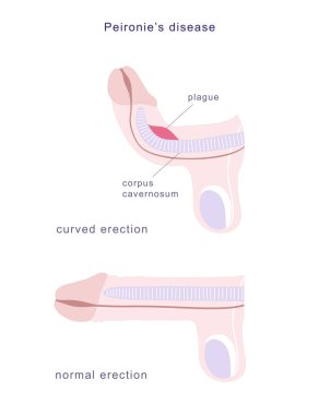 Medical chart of Peironies disease. Side view of human penis in normal erection and curved, demonstrating fibrous plague on its erectile tissue. Vector illustration
