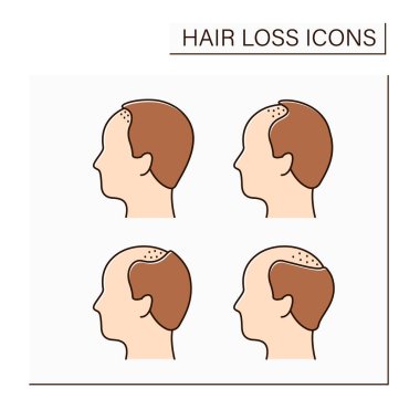 Saç dökülmesi renk simgeleri ayarlandı. Erkekte kellik sınıflandırması. Tedavi ve bakım. Alopecia konsepti. İzole vektör illüstrasyonu