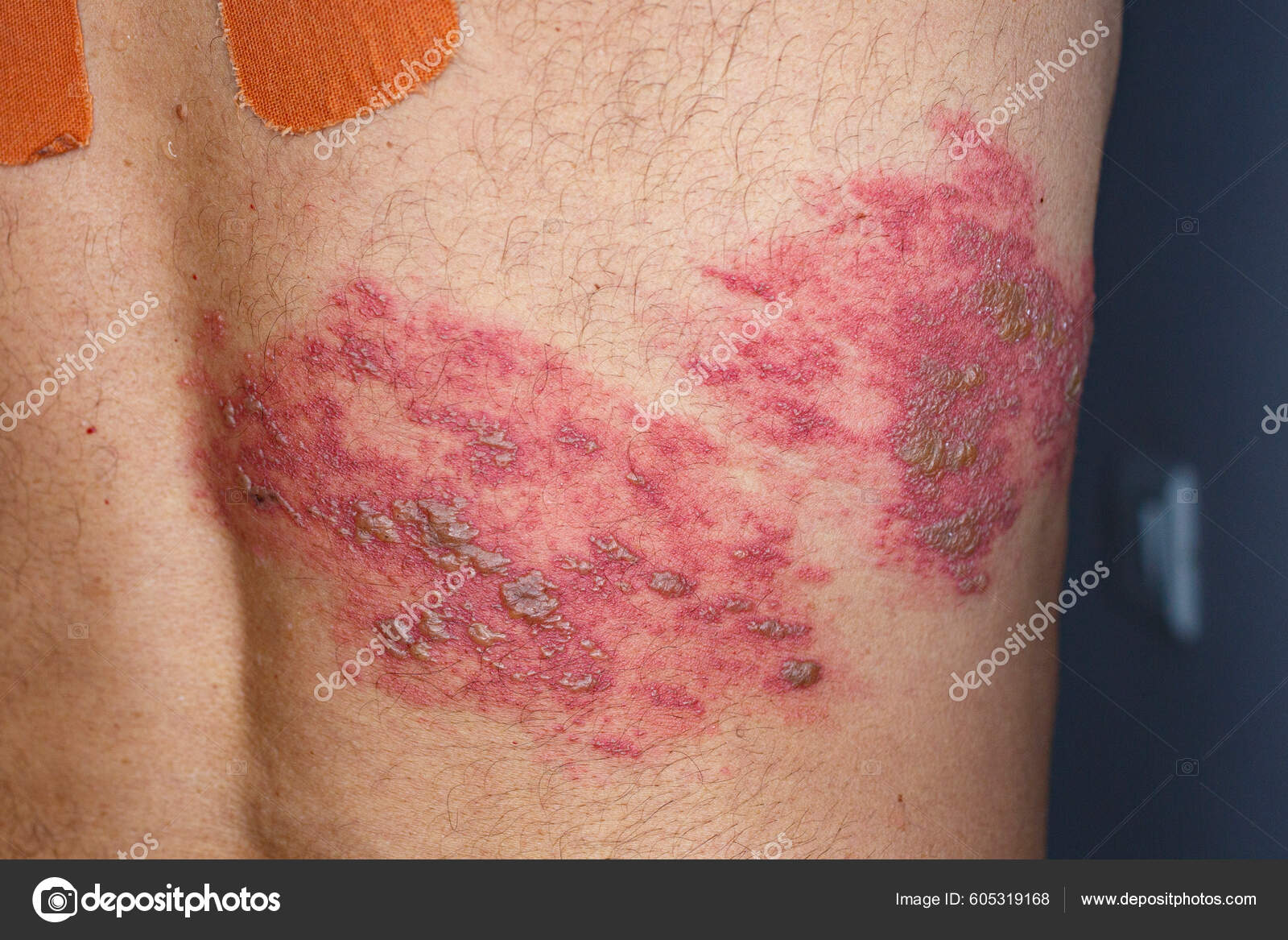 What does shingles look like cheap factory clc cet edu