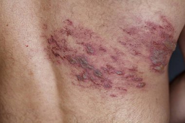 Skin lesion symptom in Shingles or Herpes zoster in human. Shingles or Herpes zoster is aviral disease caused by varicella zoster virus charatrized by a painful skin rash with blisters on the body.