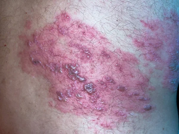 Skin Lesion Symptom Shingles Herpes Zoster Human Shingles Herpes Zoster — ストック写真