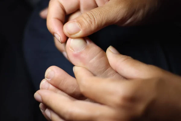 Ingrown Nail Toe Painful — Stock Photo, Image