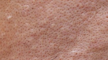 Koruyucu giysi ve sivilce giymediğin için kimyasallar cildine zarar verebilir.