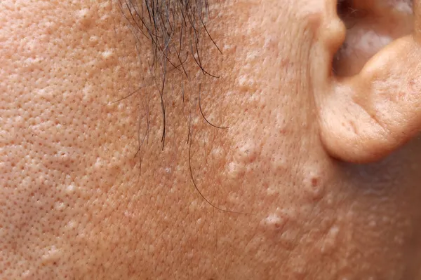 Kimyasal maddeler cildinize zarar verebilir çünkü kimya endüstrisinde çalışırken koruyucu giysi ve sivilce kullanmazsınız.