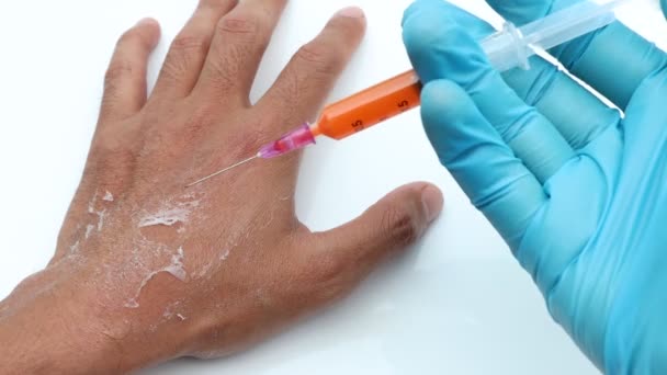 Εκδορές Του Δέρματος Που Προκαλούνται Από Διαβρωτική Χημική Ουσία Χημεία — Αρχείο Βίντεο
