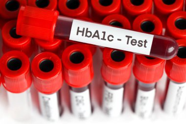 HbA1c test from blood , Blood samples to be analyzed in the laboratory, red blood in test tube 
