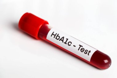 HbA1c test from blood , Blood samples to be analyzed in the laboratory, red blood in test tube 