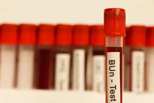 BUn  test from blood , Blood samples to be analyzed in the laboratory, red blood in test tube