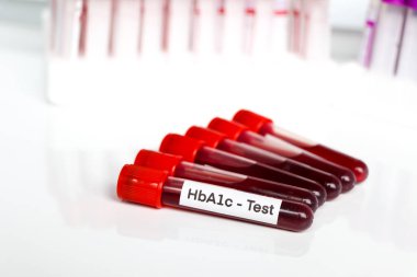 HbA1c test from blood , Blood samples to be analyzed in the laboratory, red blood in test tube 