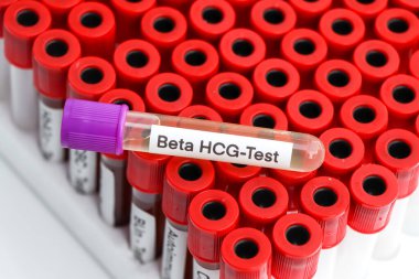 Laboratuvarda HCG testi için idrar örnekleri test tüpünde idrar örneği.