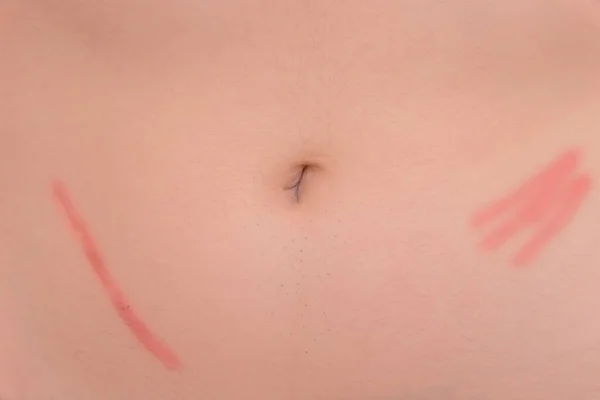 Cicatriz Piel Del Abdomen Después Extirpación Apendicitis Consecuencias Cirugía Primer —  Fotos de Stock